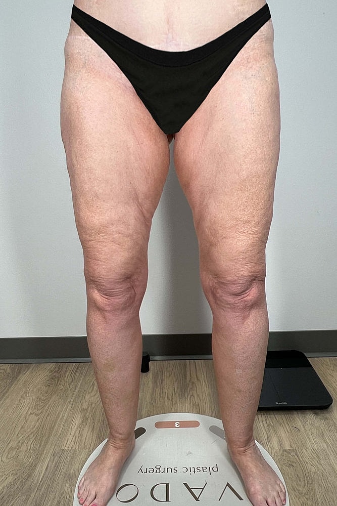 Thigh Lift Before & After