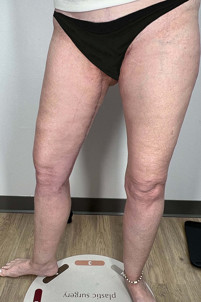 Thigh Lift Before & After