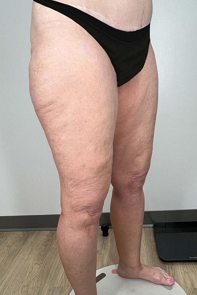 Thigh Lift Before & After