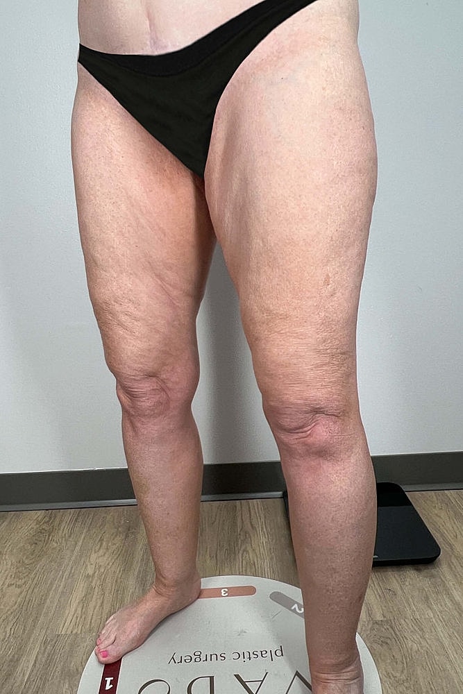 Thigh Lift Before & After