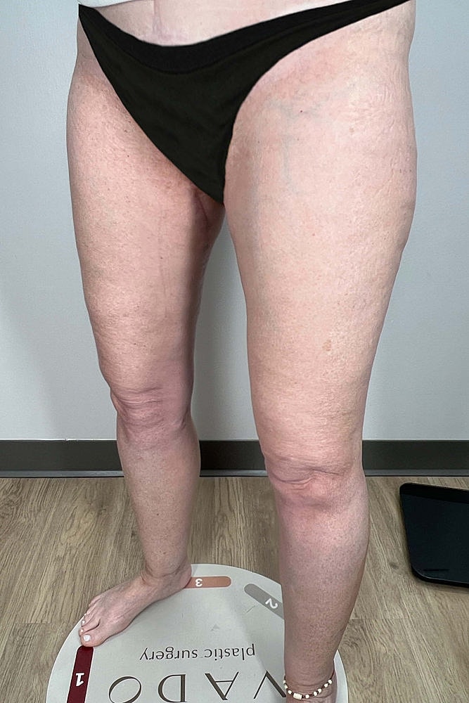 Thigh Lift Before & After