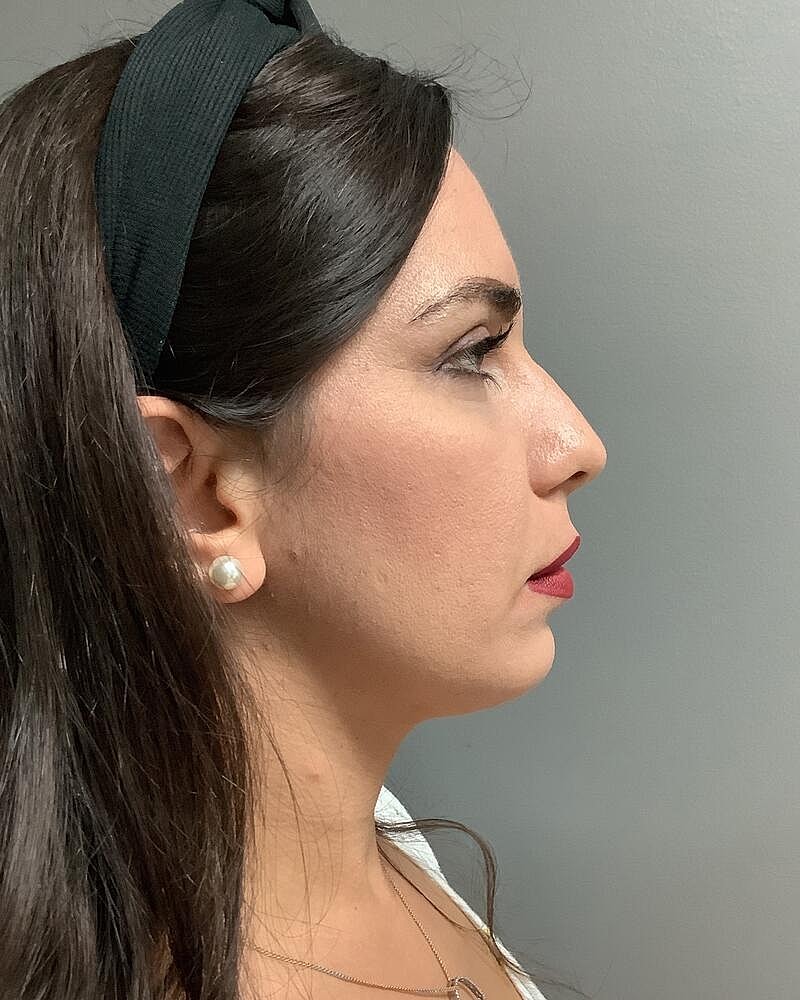 Chin Augmentation Before & After