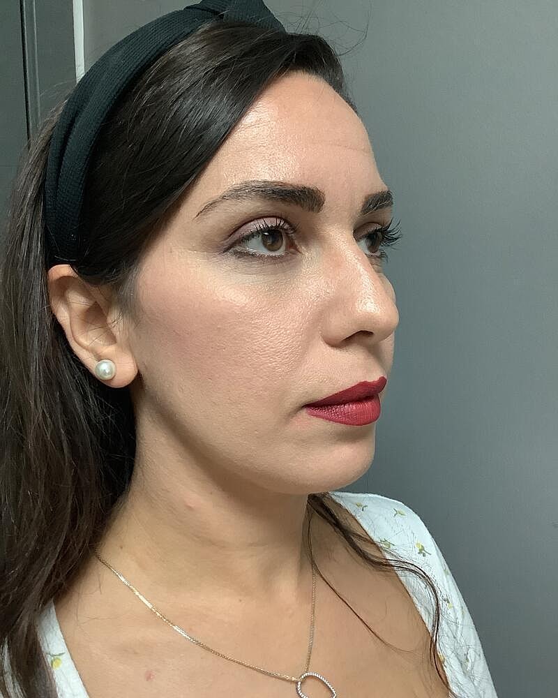 Chin Augmentation Before & After