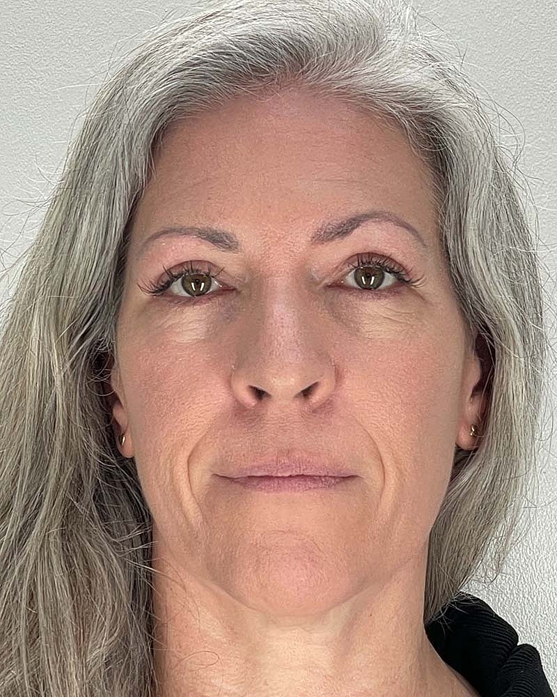 Blepharoplasty Before & After