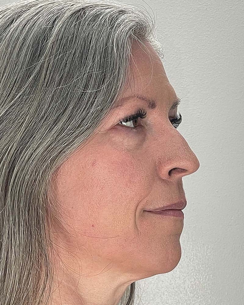 Blepharoplasty Before & After