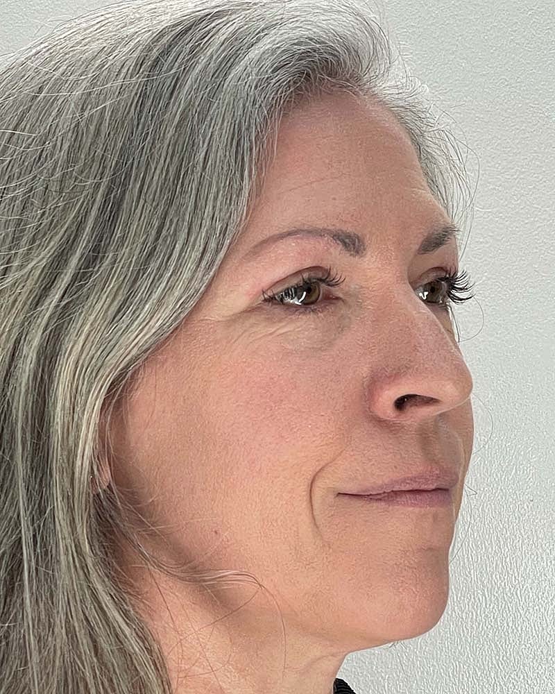 Blepharoplasty Before & After