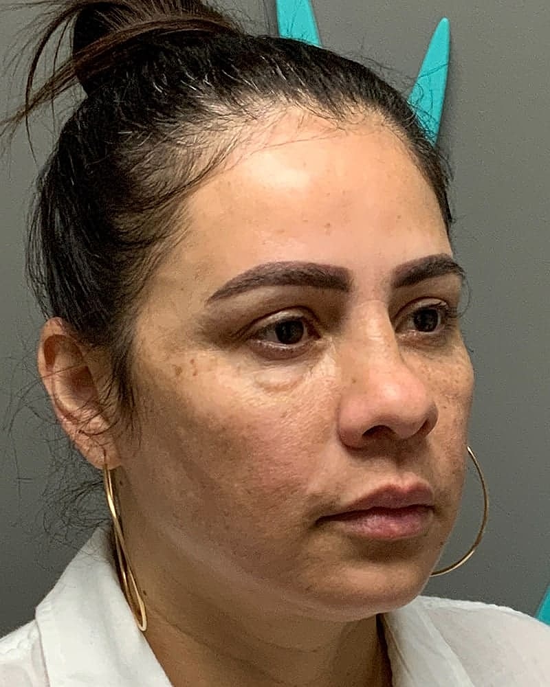 Blepharoplasty Before & After