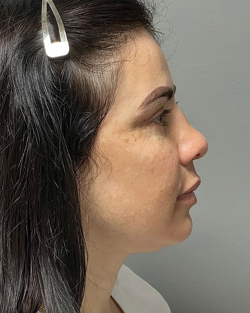 Blepharoplasty Before & After