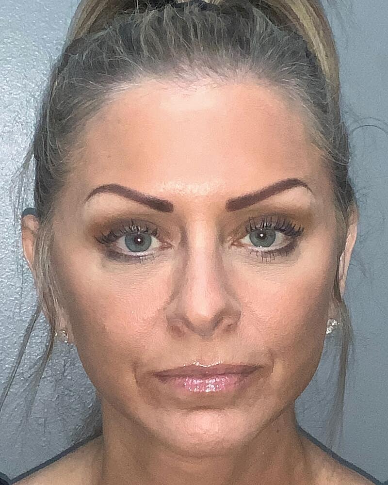 Blepharoplasty Before & After