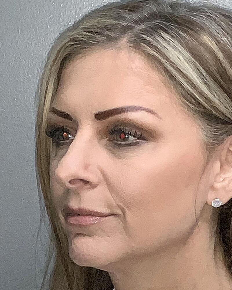 Blepharoplasty Before & After