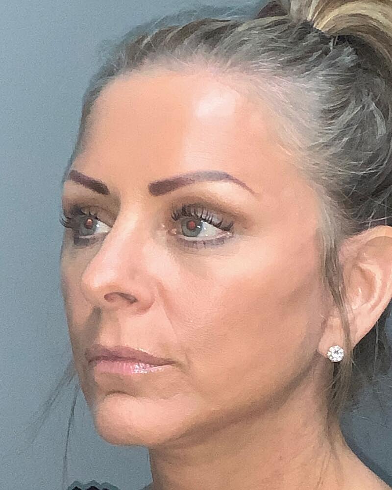 Blepharoplasty Before & After