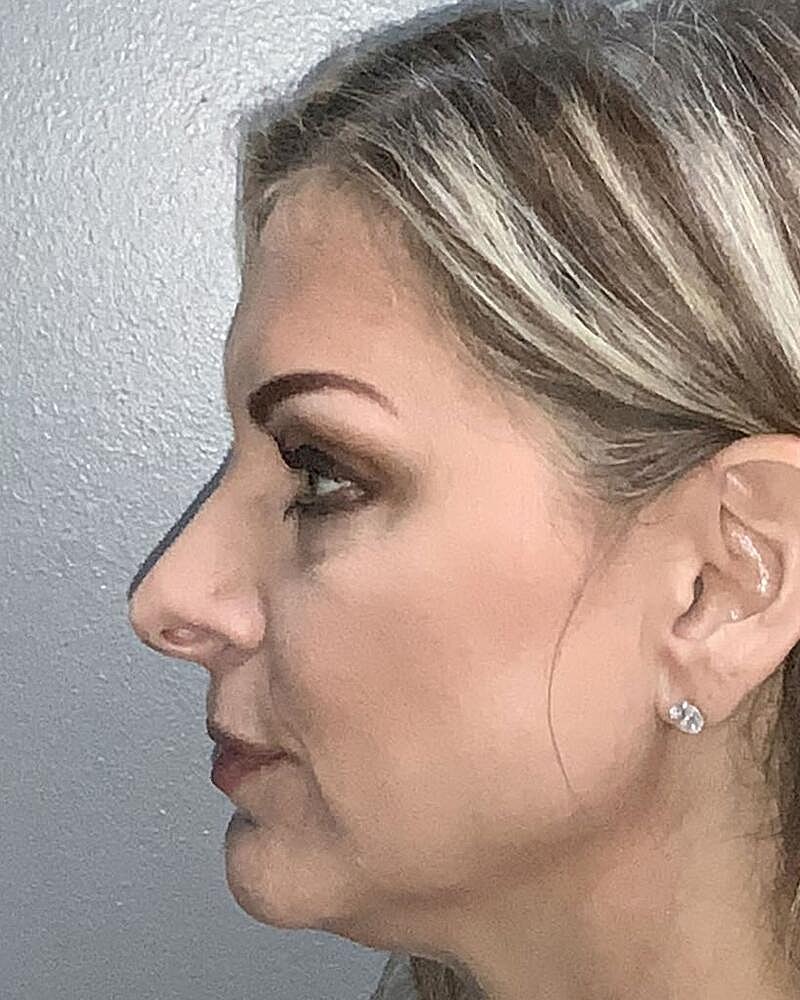 Blepharoplasty Before & After