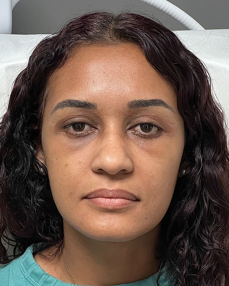 Blepharoplasty Before & After