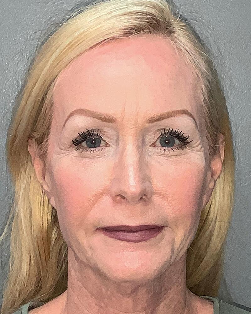 Blepharoplasty Before & After