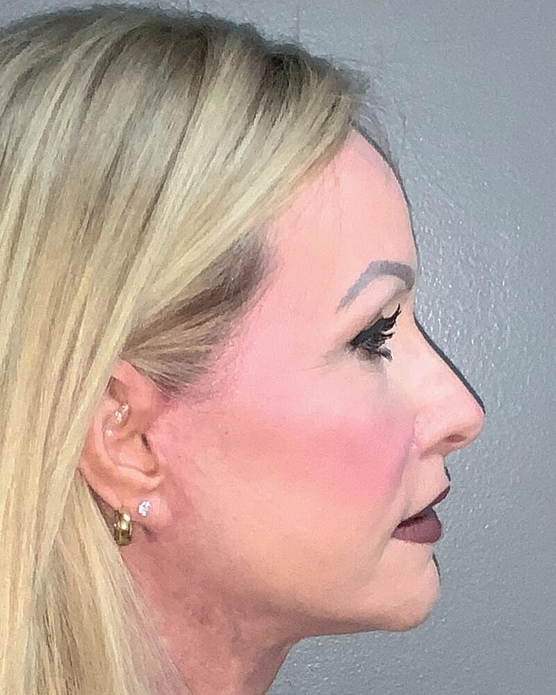 Blepharoplasty Before & After