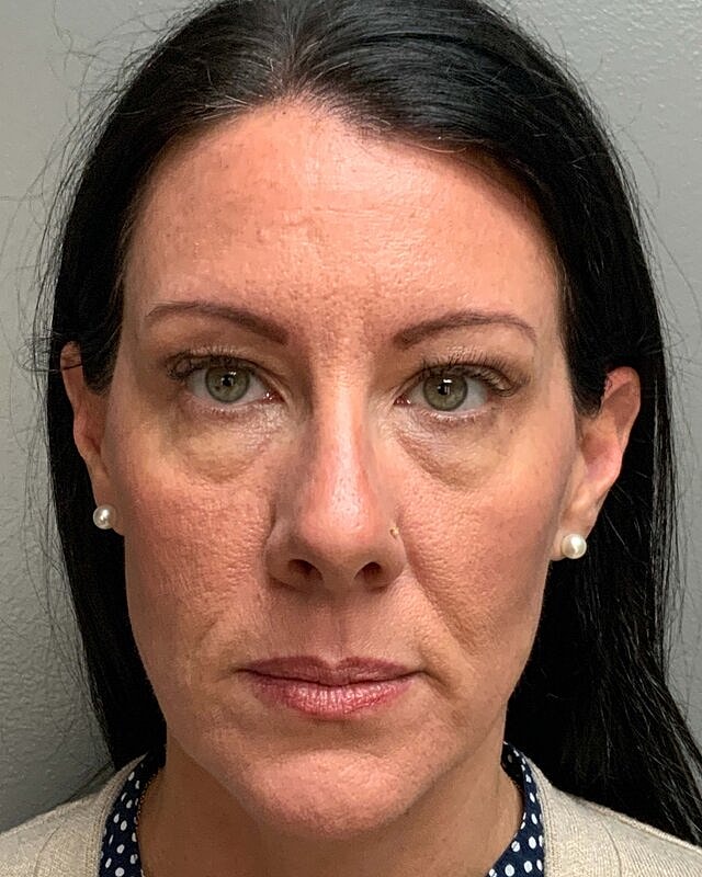 Blepharoplasty Before & After