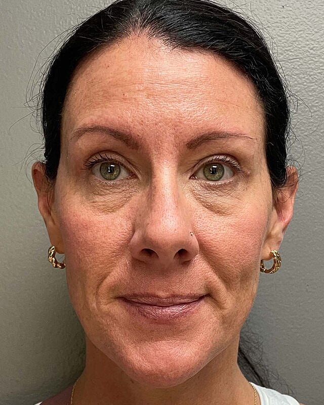 Blepharoplasty Before & After