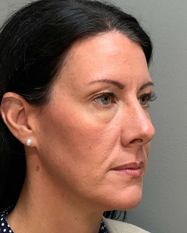 Blepharoplasty Before & After