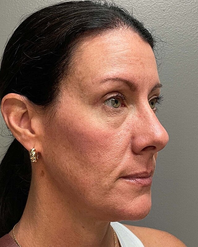 Blepharoplasty Before & After