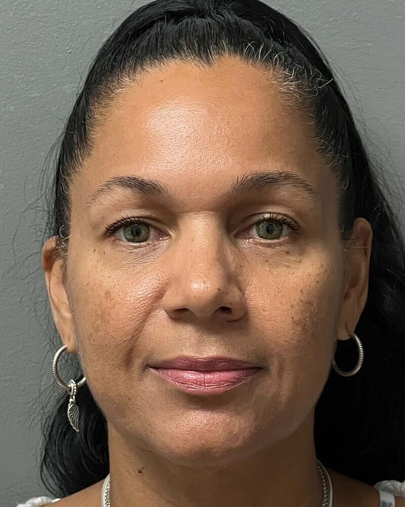 Blepharoplasty Before & After