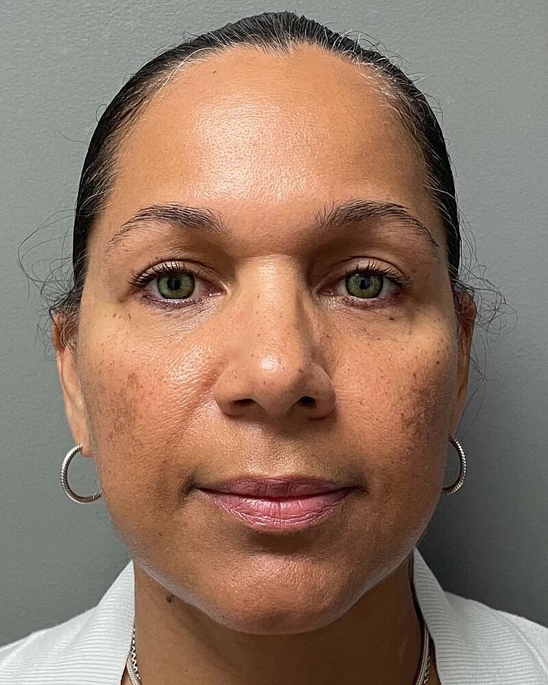 Blepharoplasty Before & After