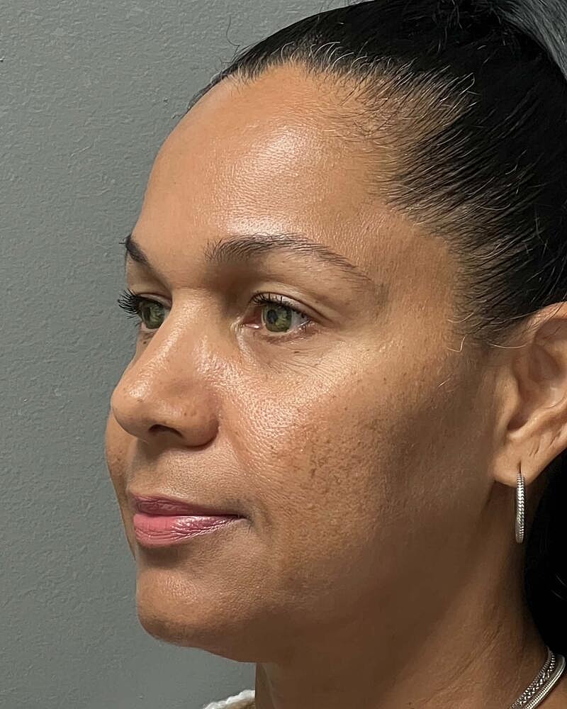 Blepharoplasty Before & After