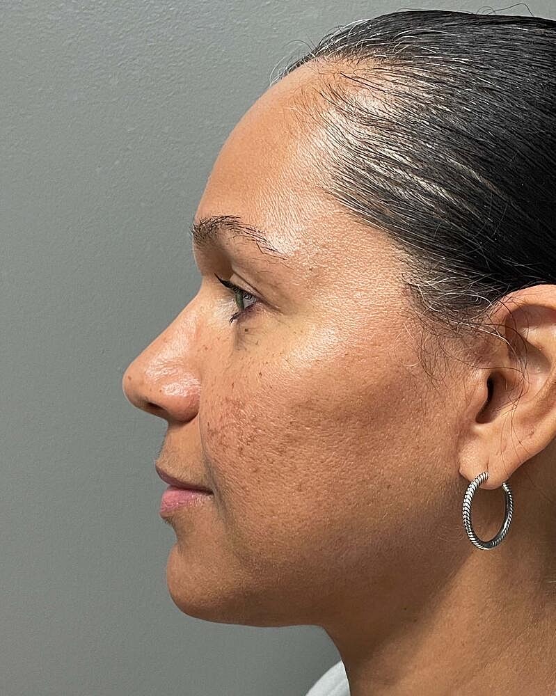 Blepharoplasty Before & After