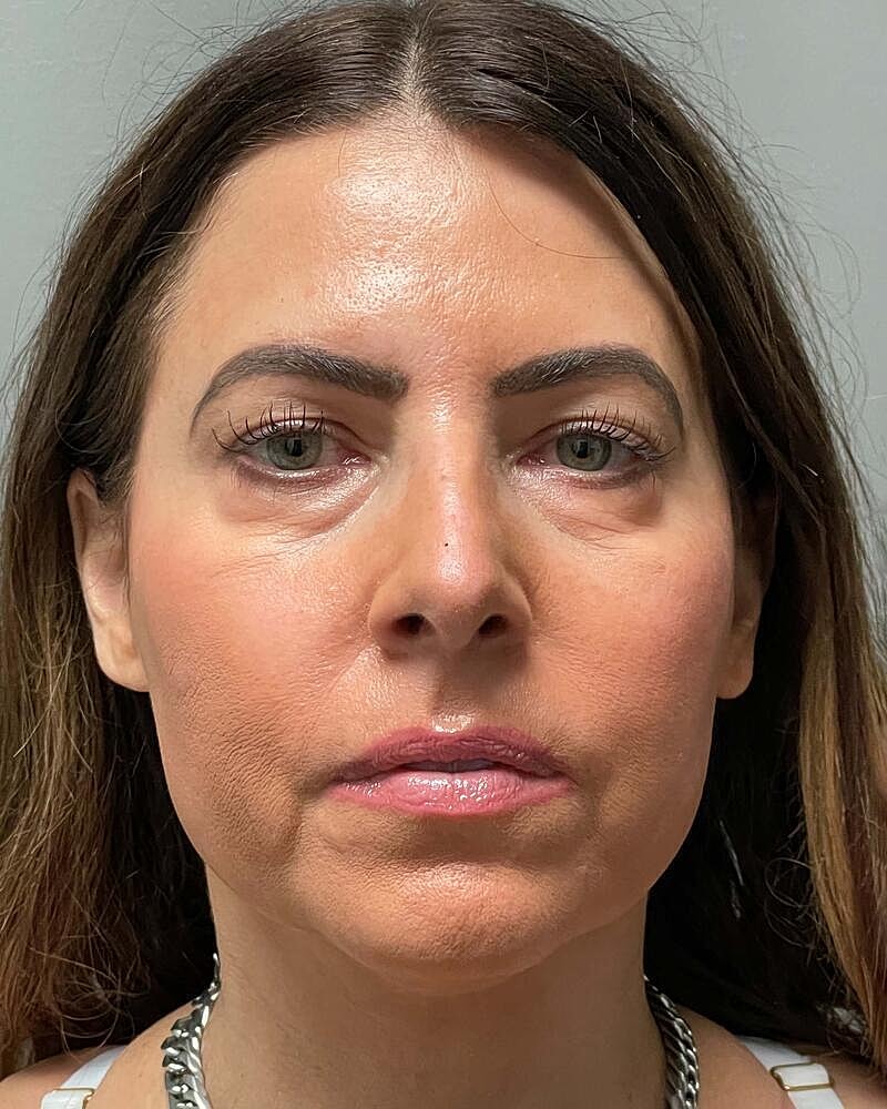 Blepharoplasty Before & After