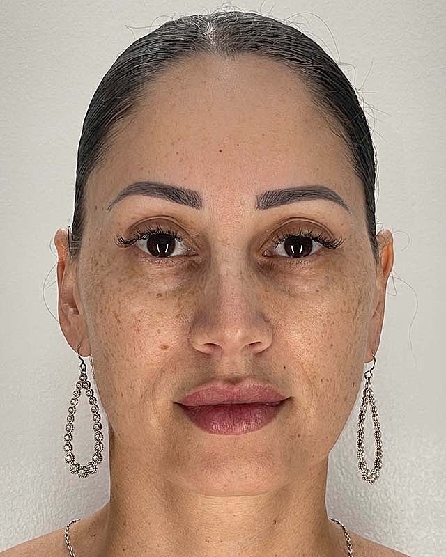 Blepharoplasty Before & After