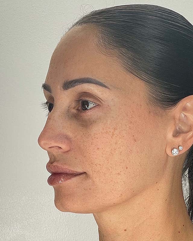 Blepharoplasty Before & After