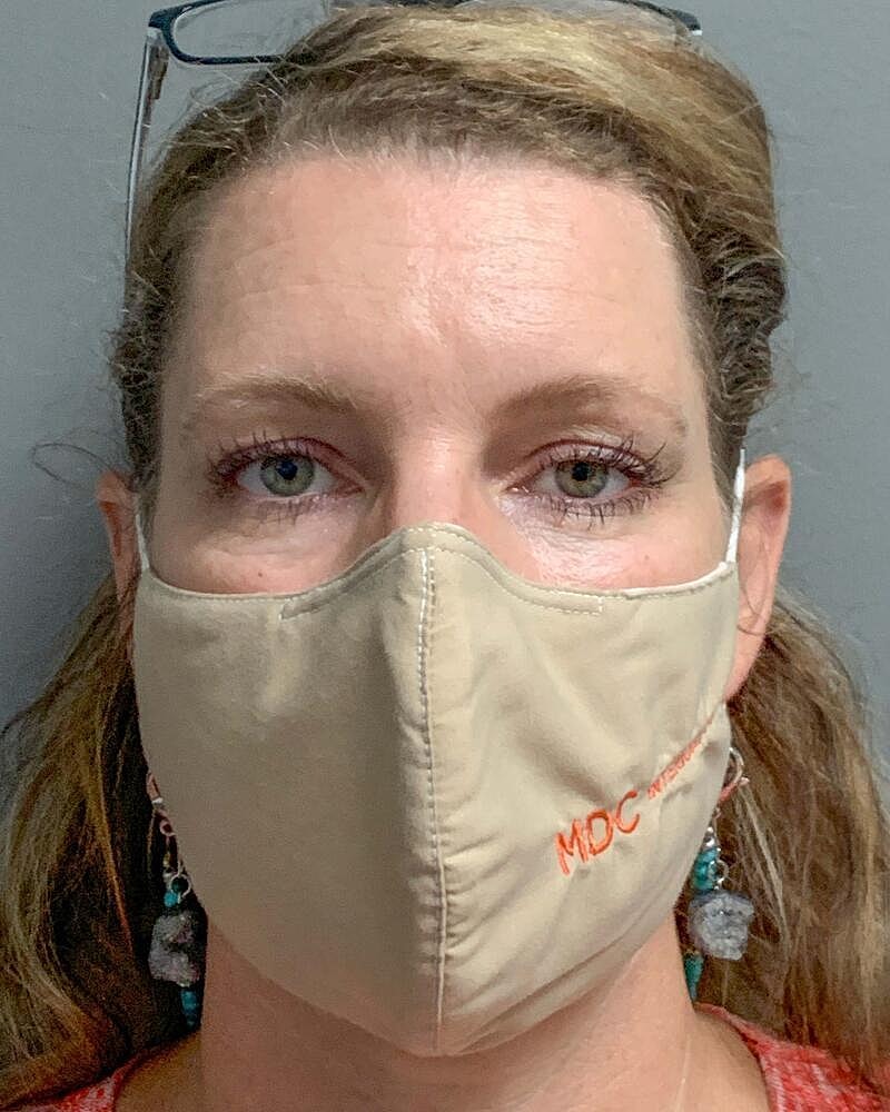 Blepharoplasty Before & After