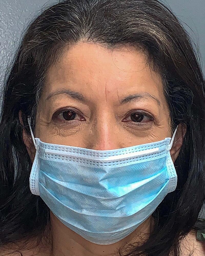 Blepharoplasty Before & After