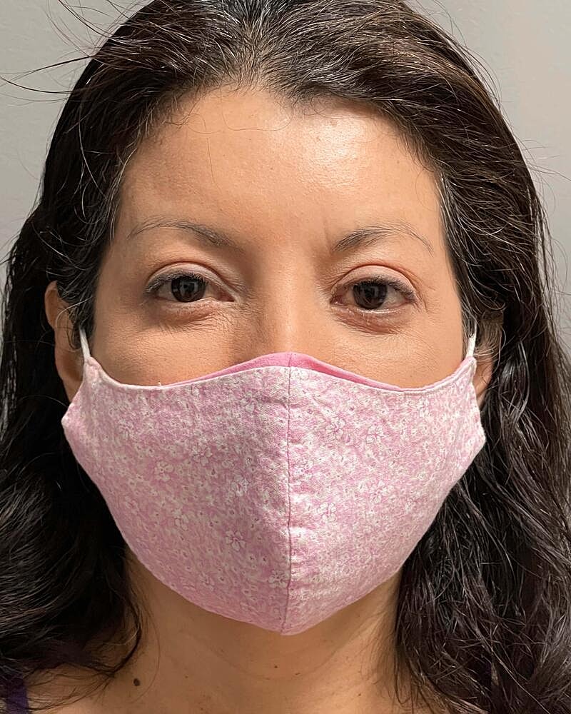 Blepharoplasty Before & After