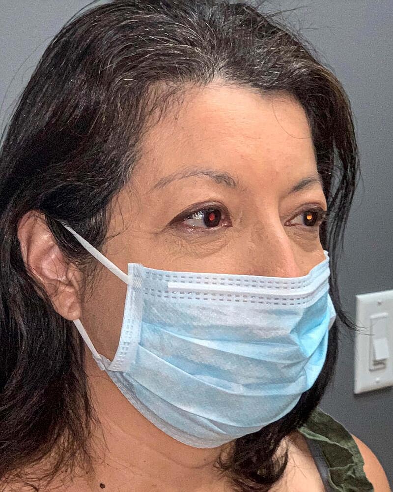 Blepharoplasty Before & After