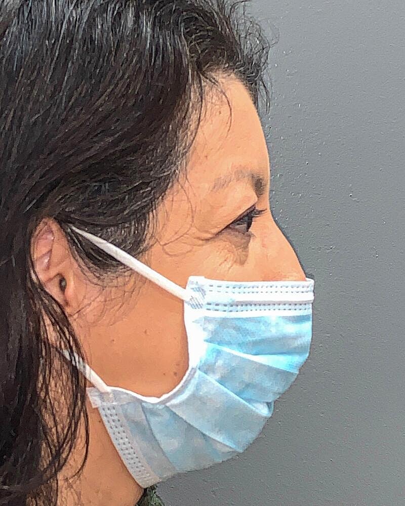 Blepharoplasty Before & After