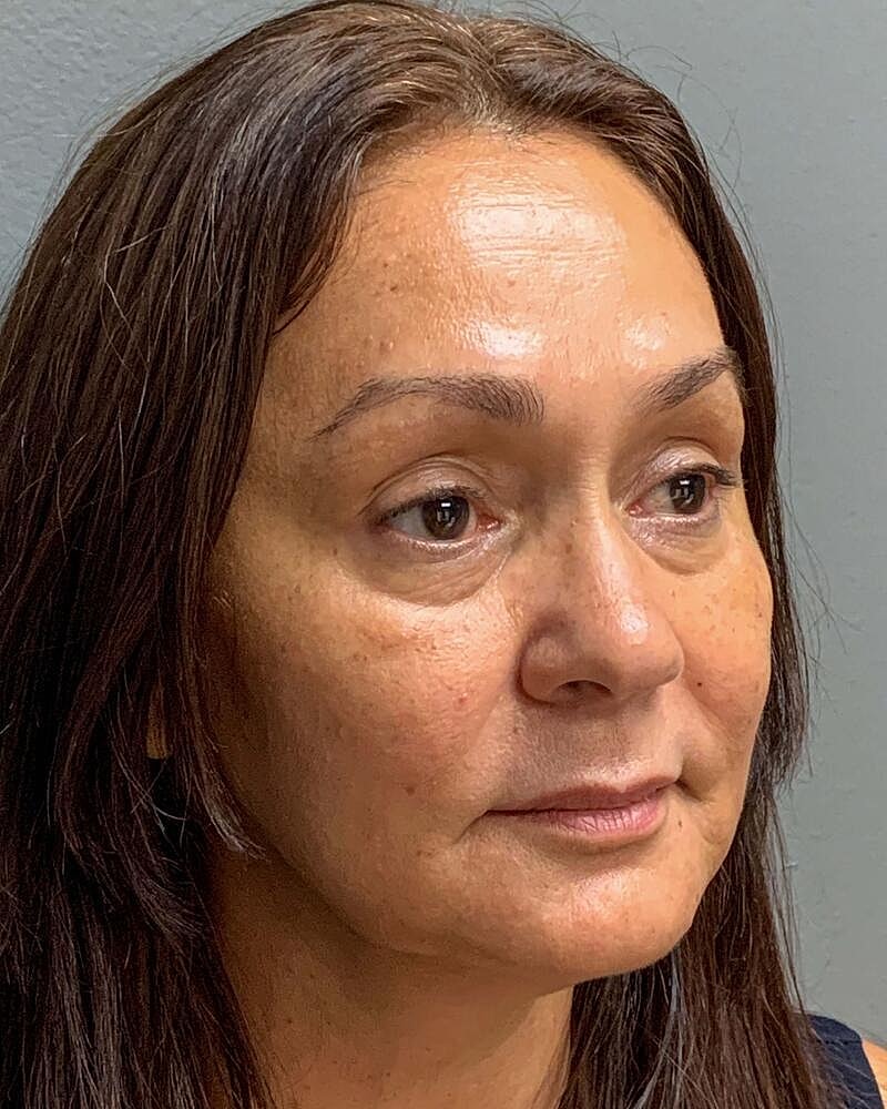 Blepharoplasty Before & After
