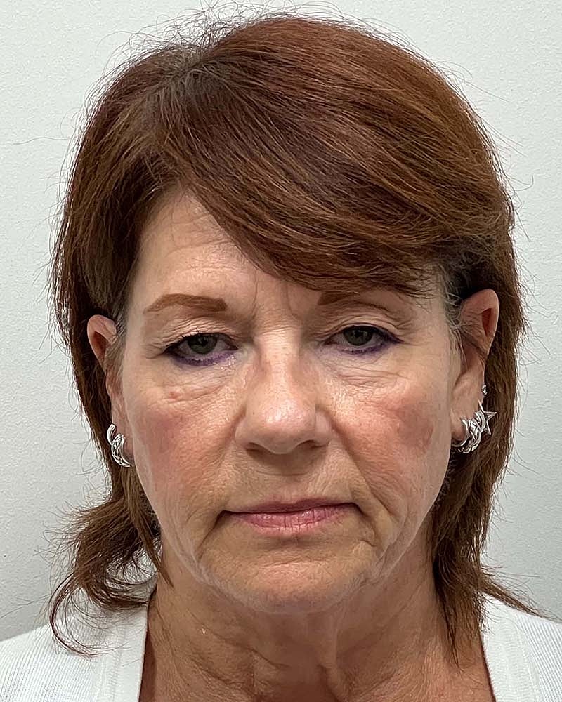 Blepharoplasty Before & After