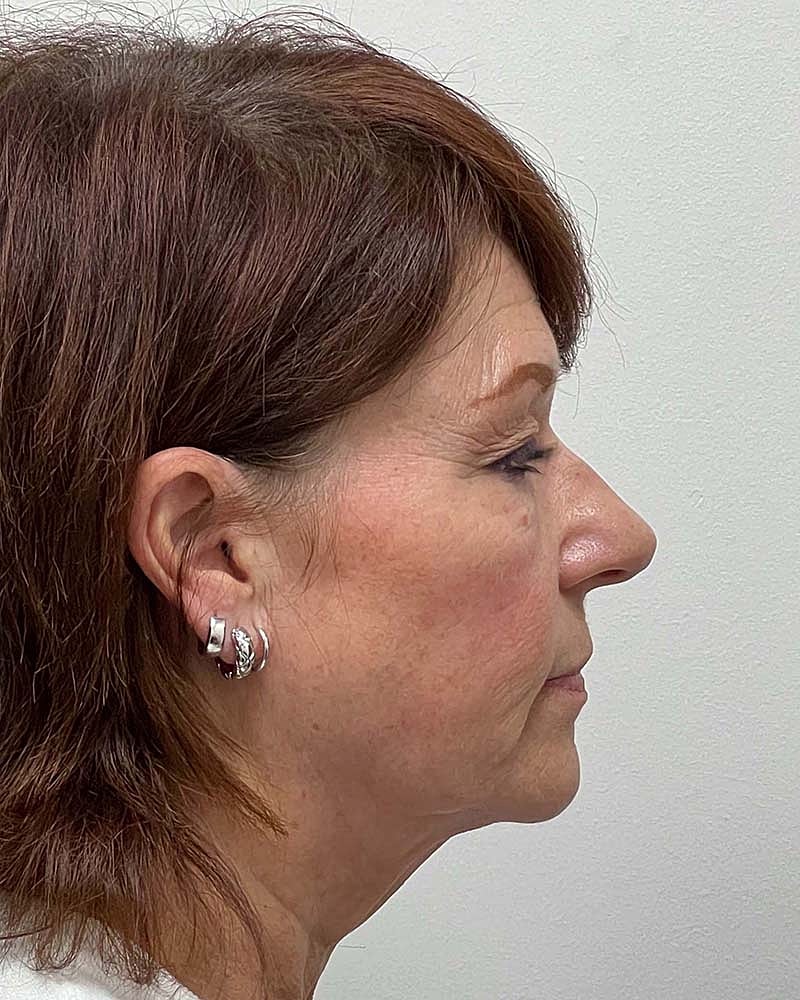 Blepharoplasty Before & After