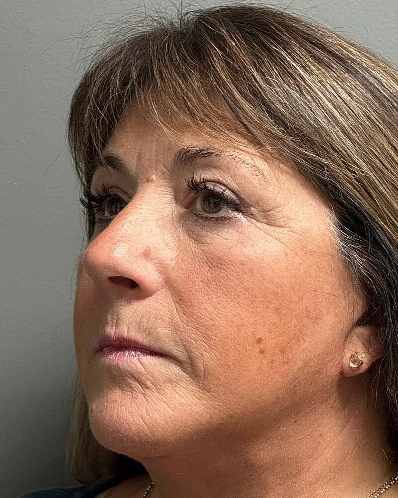 Blepharoplasty Before & After