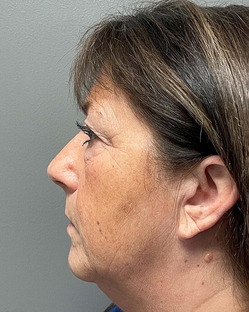 Blepharoplasty Before & After