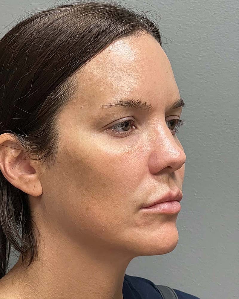 Blepharoplasty Before & After
