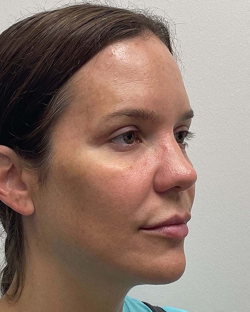 Blepharoplasty Before & After