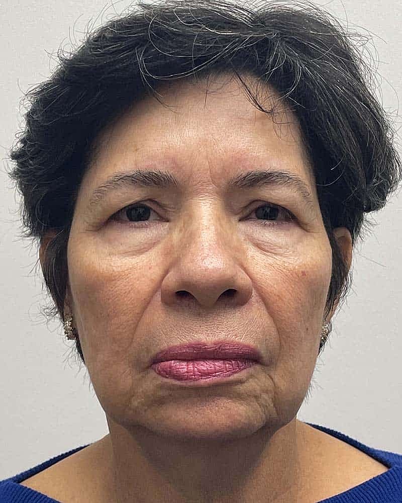 Blepharoplasty Before & After