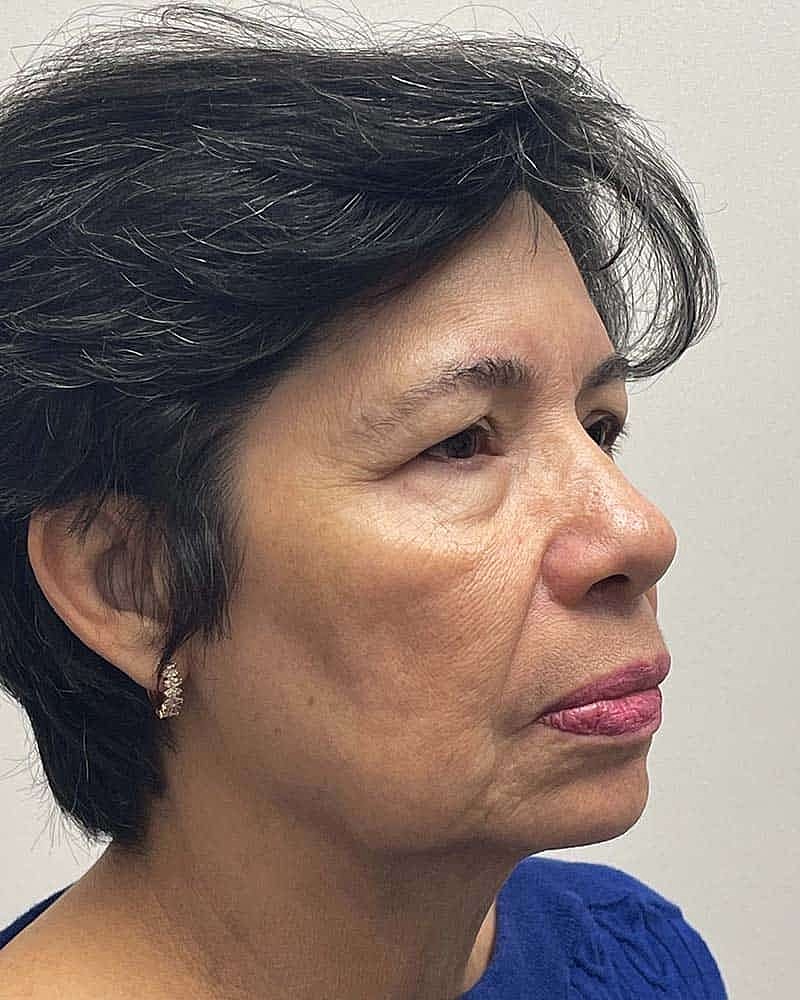 Blepharoplasty Before & After
