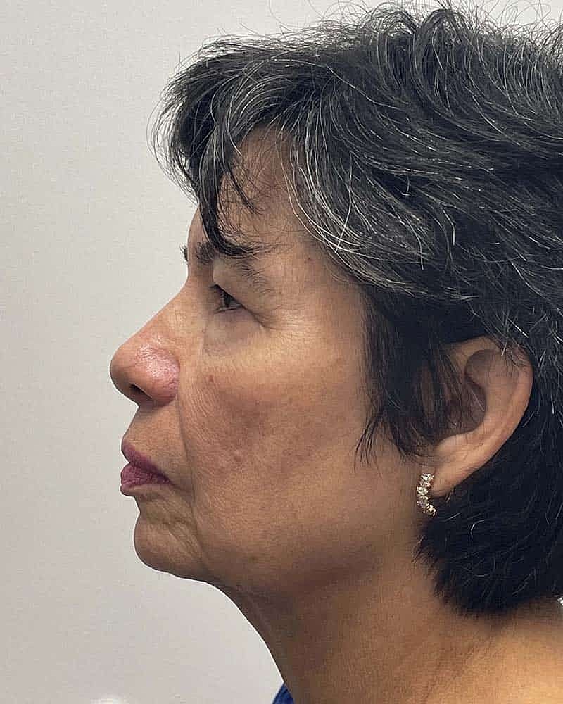 Blepharoplasty Before & After