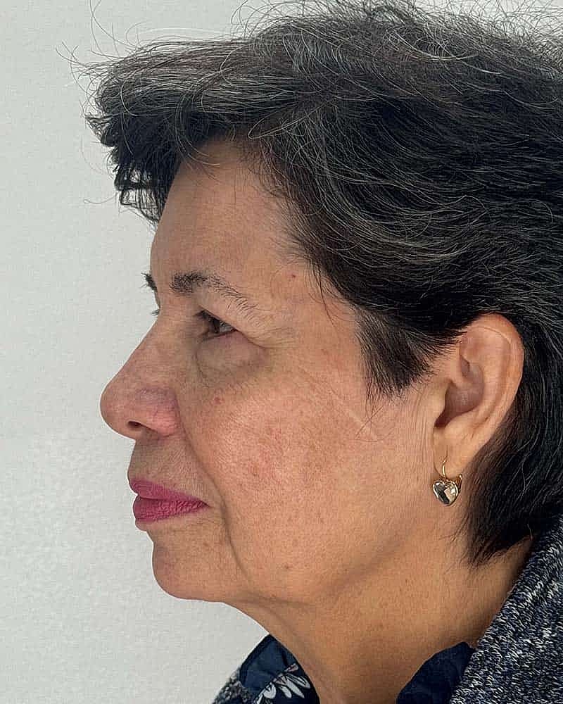 Blepharoplasty Before & After