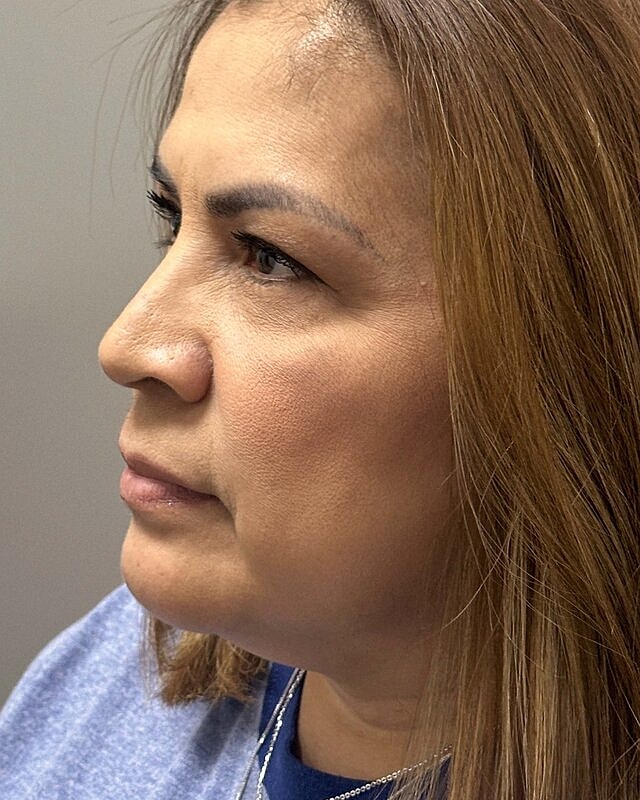 Blepharoplasty Before & After