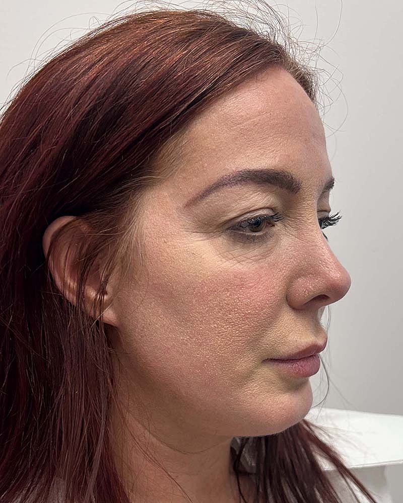 Blepharoplasty Before & After