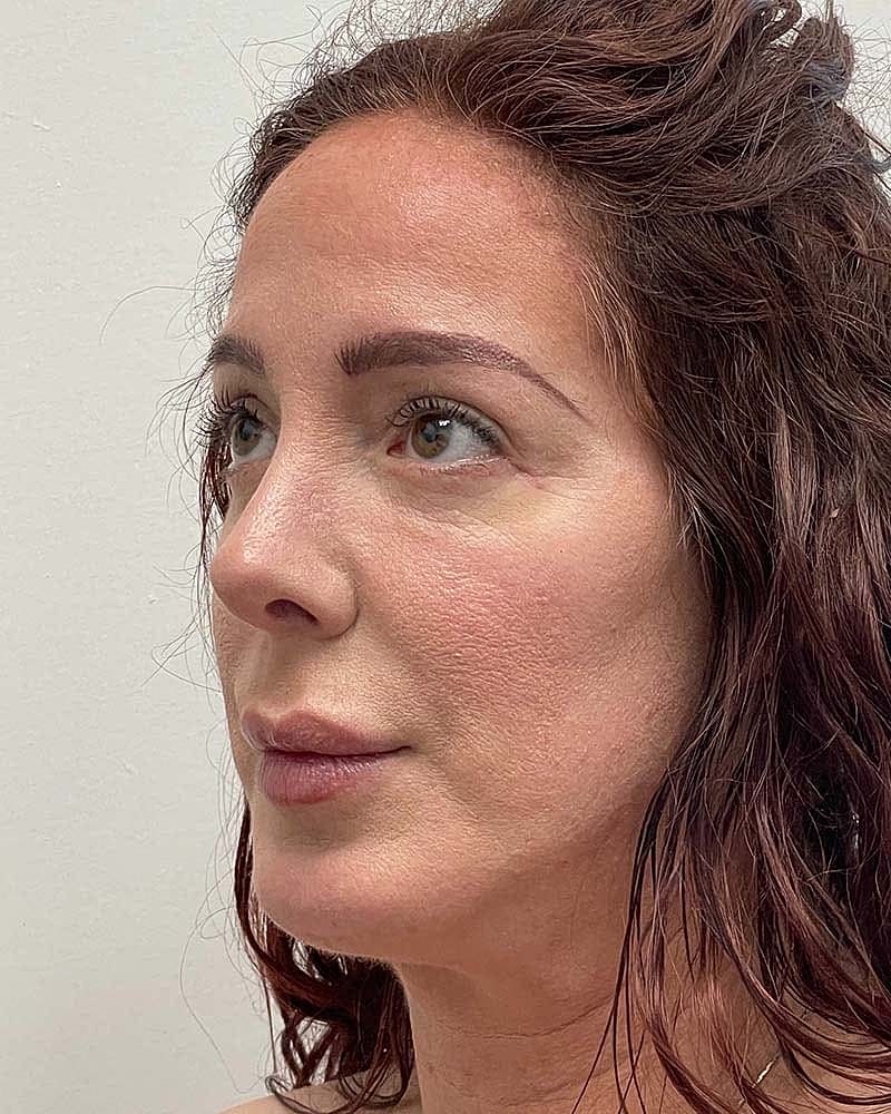 Blepharoplasty Before & After