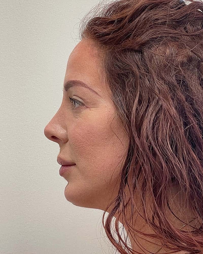 Blepharoplasty Before & After
